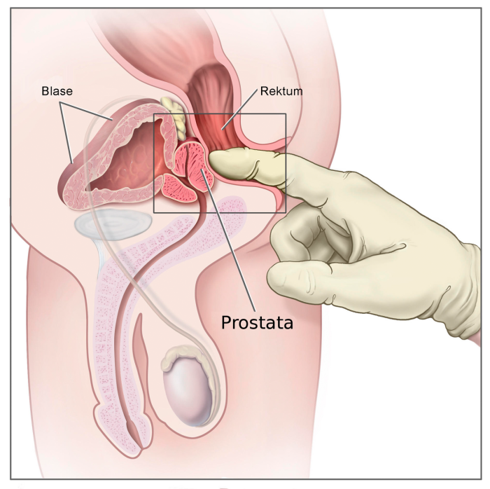 Masaje prostática